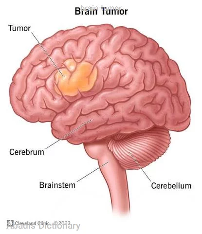 brain tumor